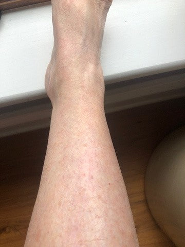 The same leg six months later, the scar faded